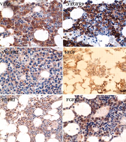Figure 2. Angiogenic cytokine and cytokine receptor expression by immunohistochemistry. Photomicrographs taken during bone marrow biopsy demonstrate positive plasma cell expression of VEGF, bFGF, VEGFR1, VEGFR2, FGFR2, and FGFR3 by immunohistochemistry. Pictures obtained at 100×/0.3 (magnification/aperture).