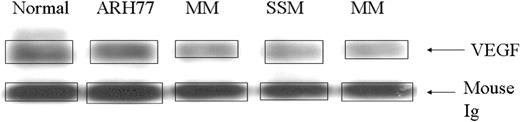Figure 5. Expression of VEGF using Western blot analysis. Representative blots of VEGF expression by plasma cells in normal bone marrow, MM, and SMM after immunoprecipitation. The ARH 77 cell line was used as an additional control. Densitometric readings for cytokine/receptor bands were obtained and corrected to the corresponding mouse immunoglobulin band (shown below the VEGF band) derived from the immunoprecipitation antibody.
