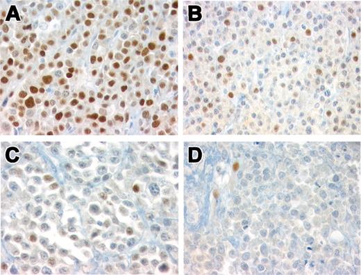 Figure 3. Immunohistochemical analysis of cyclin D1 in 48 MMs. (A) Representative case of MM group 1 showing strong, homogenous, cyclin D1 nuclear staining in the majority of tumor cells (> 80%, +++). Immunoperoxidase staining; original magnification × 400. (B) A representative case with intermediate cyclin D1 protein expression (++). Nuclear positivity is detected in 20% to 50% of the tumor cells. Note that the intensity of the staining varies from cell to cell. Immunoperoxidase staining; original magnification × 400. (C) MM with nuclear positivity in 10% to 20% of tumor cells (+) representing low levels of protein expression. Immunoperoxidase staining; original magnification × 640. (D) MM negative for cyclin D1. Note the positivity in endothelial cells used as internal control. Immunoperoxidase staining; original magnification × 640.