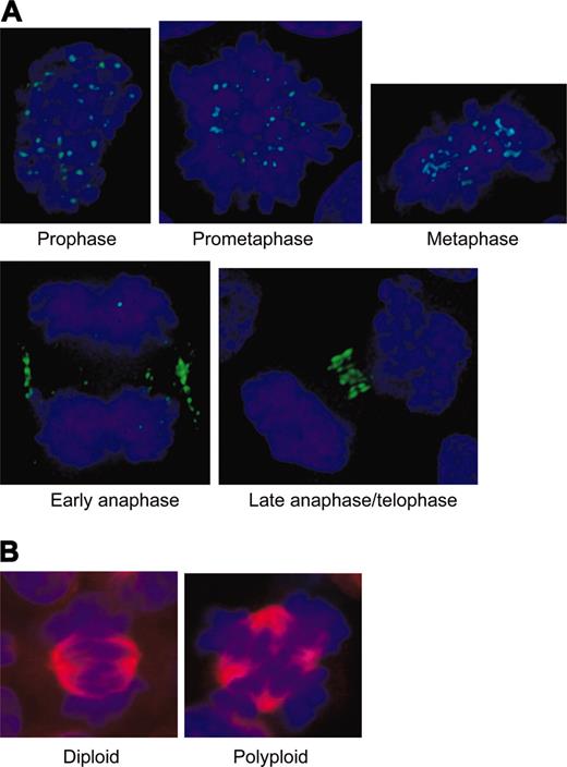 Figure 2. Diploid controls for Aurora-B kinase localization in mitosis. (A) Diploid CD34+ cells showing expected pattern of Aurora-B kinase localizing to centromeres in prophase through metaphase, then transferring to the midzone cortex and the condensing midbody in anaphase. Note chromosomal organization defining the different stages with condensation beginning at prophase, chromosomal alignment occurring at metaphase, sister chromatid separation in early anaphase with spindle elongation, and the beginning of chromosome decondensation in late anaphase and telophase. (B) Comparison of a diploid metaphase (bipolar spindle, single metaphase plate) with a polyploid metaphase (more than 2 spindle poles and more than a single metaphase plate).