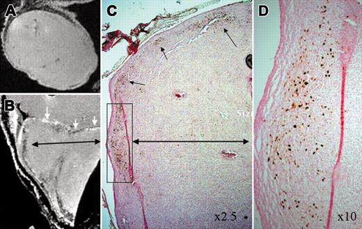 Figure 3. MRI of labeled CD34+ cells in tumors. (A) Magnetic resonance imaging (MRI) of tumor with unlabeled CD34+ cells, (B) MRI of tumor with labeled CD 34+ cells, (C) DAB-enhanced Prussian blue staining of tumor with labeled cells. Note low signal intensity along the margin of the tumor, which corresponds with the iron-positive cells on Prussian blue staining. (D) Enlarged inset from panel C, original magnification × 10. White arrows indicate the margin of the tumor and black arrows indicate the accumulation of iron-positive cells.