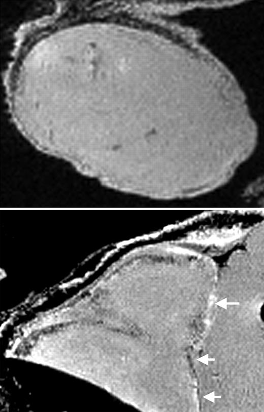 MRI of labeled CD34+ cells in tumors. See the complete figure in the article beginning on page 1217.
