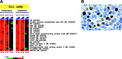 Figure 4. p53-dependent gene expression. (A) p53-dependent gene expression response of CLL cells in vitro following treatment with fludarabine or irradiation. Gene expression changes at 24 hours (1 day) and 48 hours (2 days) are displayed for each gene relative to its expression in control cultures. In CLL patients 15 and 53, fludarabine treatment and irradiation were cytotoxic, whereas no effect of either treatment was observed in CLL patient 31, who was clinically resistant to fludarabine. (B) Immunohistochemical staining for p53 in CLL 31, demonstrating overexpression in approximately 30% of tumor cells. The image was obtained using a Zeiss Axioplan 2 microscope, 100 ×/1.4 N.A. planar apochromatic oil immersion objective, and MicroMAX digital camera (Princeton Instruments, Trenton, NJ), and then processed with IPLab Spectrum (Signal Analytics, Vienna, VA) and Adobe Photoshop Software.