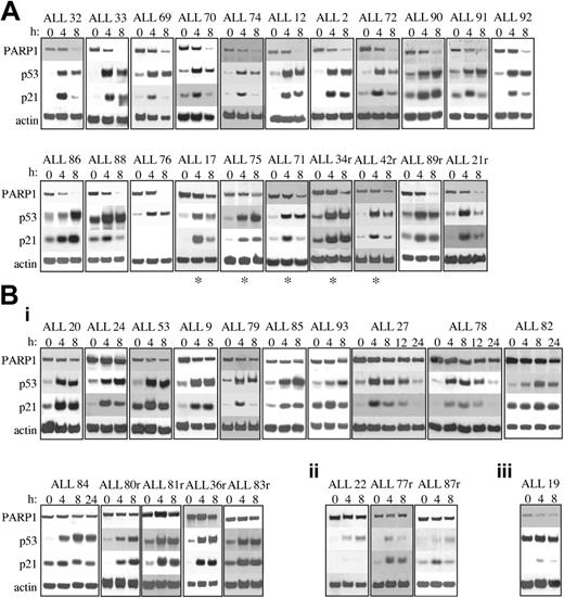 Figure 1. Western blot analysis of PARP1, p53, and p21 proteins after 5 Gy IR. (A) Twenty-one of 40 B-precursor ALL tumors exhibited normal apoptotic responses after IR showing PARP1 cleavage and normal p53 and p21 protein accumulation. ALL 76 showed no p21 protein induction but did exhibit PARP1 cleavage. (B) Nineteen of 40 with B-precursor ALL tumors exhibited defective apoptotic responses after IR. Actin shows equal loading. (i) Fifteen with ALL tumors exhibited defective PARP1 cleavage after IR despite normal p53 and p21 protein accumulation. (ii) Three ALL tumors exhibited defective PARP1 cleavage and defective activation of p53 and p21 proteins after IR, suggesting a defect upstream of p53. (iii) One ALL tumor exhibited high basal levels of p53 protein with no further accumulation of p53 or p21 proteins after IR, suggesting a TP53 mutation. r indicates relapse sample; and *, delayed PARP1 cleavage.