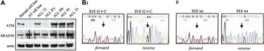 Figure 2. Confirmation of defects in the p53 pathway. (A) Western blot of ATM protein showing reduced ATM expression in ALL87r, similar to the control ataxia telangiectasia cell line. Actin shows equal loading; hRad50, a high–molecular weight protein, demonstrates an absence of sample degradation. (B) Chromatogram of the TP53 gene sequence in ALL 19. The arrow indicates the position of the mutated nucleotide. (i) A heterozygous missense 818G>C mutation was identified in the tumor DNA. (ii) The sequence was wild type at the same position in the germline DNA.
