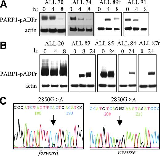 Figure 5. Western blot analysis showing levels of pADPr attached to the PARP1 protein (PARP-pADPr) as an indication of PARP1 activity after 5 Gy IR. (A) Apoptosis-proficient ALL tumors showed pADPr degradation by 8 hours after IR. (B) Apoptosis-resistant ALL tumors showed an absence of pADPr degradation up to 24 hours after IR. (C) Chromatogram of the PARP1 gene sequence in ALL 20. Forward and reverse primer sequencing identified a heterozygous missense 2850G>A mutation in the tumor DNA. The arrow indicates the position of the mutated nucleotide.
