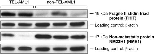 Figure 4. Concordance of protein levels and gene expression for 2 purine genes discriminating TEL-AML1–positive and TEL-AML1–negative ALL cells. FHIT and NME1 protein levels in whole cell lysates of 2 TEL-AML1–positive ALL and 3 TEL-AML1–negative ALL samples (from left to right, 2 hyperdiploid B-lineage and 1 B-lineage ALL with no defined genetic subtype) assessed by Western blotting. FHIT protein level was significantly higher and NME1 was significantly lower in TEL-AML1–positive ALL, which is concordant with the mRNA expression in these 2 groups.