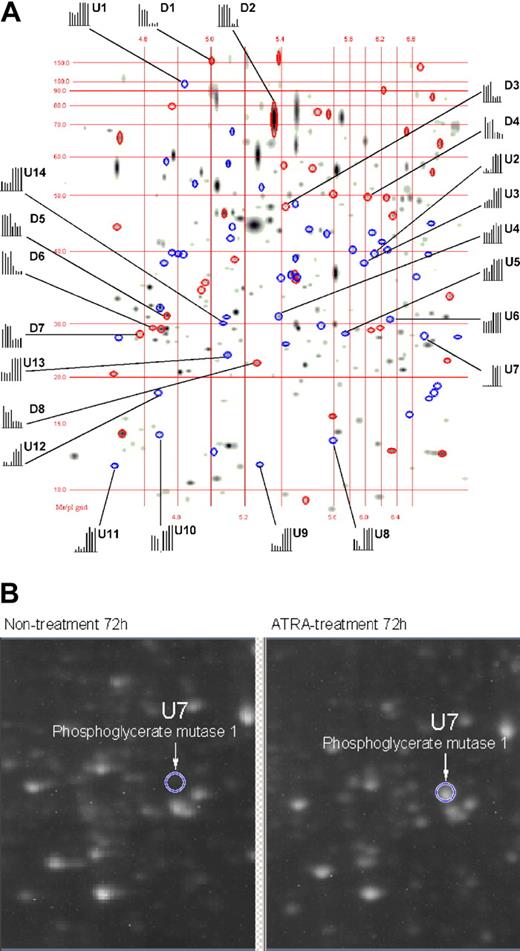 Figure 1. Matching image analysis for 2-DE. This image represents 4 nontreated 2-DE gels compared with 4 ATRA-treated 2-DE gels. The pH range was 4 to 7, with molecular weight, isoelectric point (pI) grinds, and histograms representing the quantification of identified proteins within the gels. The first 4 bars in each histogram represent the relative intensity of a protein spot from 4 individual 2-DE gels during nontreatment, and the last 4 bars represent the relative intensity of the same protein spot from 4 individual 2-DE gels during ATRA treatment. Proteins down-regulated by means of ATRA treatment are displayed as red ellipses, and up-regulated proteins are displayed as blue ellipses. Proteins labeled with “U” or “D” are listed in Table 1 along with their degree of regulation as a function of ATRA treatment. (B) A 2-DE raw image (original magnification, × 1) for nontreated and ATRA-treated 2-DE gels corresponding to the gel region where phosphoglycerate mutase 1 resolves (circle).