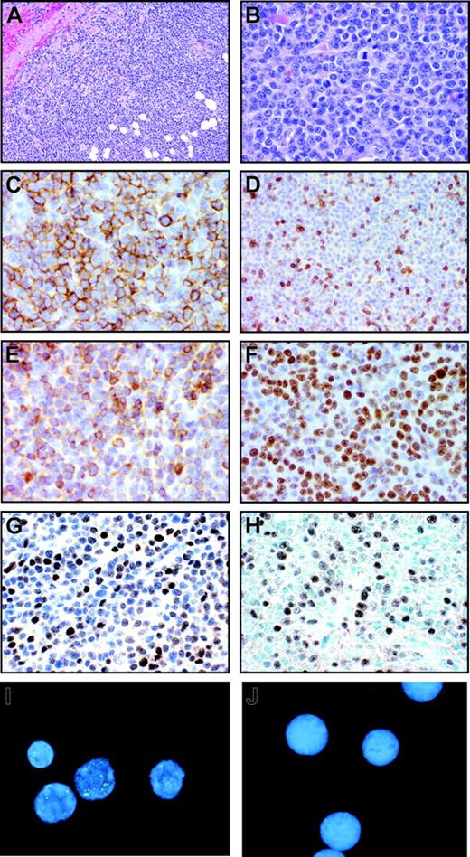 Figure 5. Rhesus LCV-positive B-cell lymphoma from Mm256-96. (A-B) Hematoxylin and eosin–stained section of submandibular tumor mass from necropsy on day 155 after intravenous inoculation of autologous rhesus LCV-immortalized B cells. Original magnification × 40 (A) and × 200 (B). (C-G) Immunohistochemical staining of tumor section for CD20 (C), CD3 (D), bcl-2 (E), Ki-67 (F), and EBNA-2 (G). Original magnification × 200. (H) In situ hybridization of tumor section for EBER expression. Original magnification × 200. (I-J) Fluorescent in situ hybridization with a rhesus LCV DNA probe on touch preps prepared from the (I) tumor section or (J) EBV-negative BJAB B lymphoma cells. Original magnification × 400.