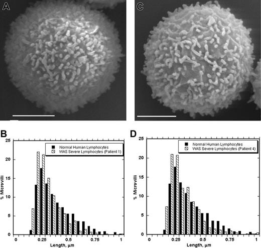Figure 6. Lymphocytes from human severe WAS patients have normal microvilli. (A,C) SEMs of representative blood lymphocytes from 2 patients with severe WAS. Scale bars represent 2 μm. (B,D) Histograms comparing microvillar lengths from normal human lymphocytes and those from the respective WAS patient. Bins are 0.05 μm. Numeric data are in Table 2.