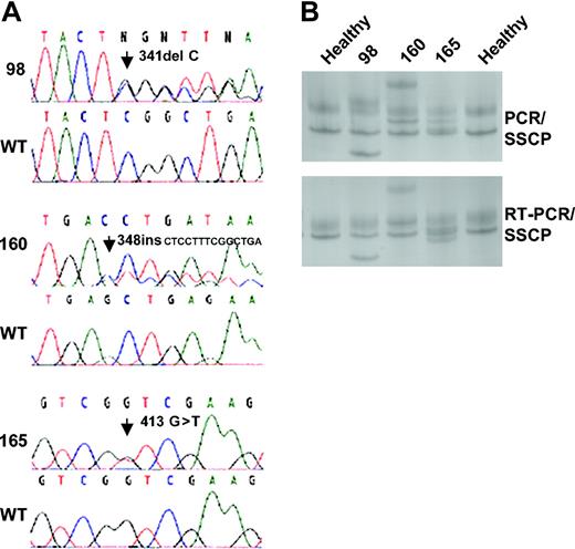 Figure 2. Direct DNA sequencing and SSCP analysis of AML1. (A) The sequences depict mutations identified in exon 4 of AML1 and the corresponding wild-type (WT) sequences. The first sequence shows a deletion of 1 nucleotide identified in patient 98, the second sequence shows a insertion of 14 nucleotides identified in patient 160, and the final sequence shows a single base substitution in patient 165. (B) Representative PCR/SSCP bands (top) and RT-PCR/SSCP bands (bottom) of exon 4. Lanes 1 and 5 are healthy controls and lanes 2 to 4 are patient nos. 98, 160, and 165.