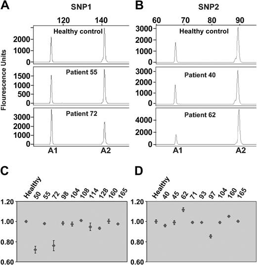 Figure 3. The allelic ratio of AML1 assessed by SNP analysis. (A-B) The representative electropherograms show the sizes and levels of allele 1 (A1) and allele 2 (A2) after restriction digestion of SNP1 in panel A and of SNP2 in panel B. Top row shows healthy controls; middle row, patients with allelic balance; and bottom row, patients with allelic ratios significantly different from the controls, suggesting allelic imbalance. (C-D) The allelic ratio is depicted as dots of the 10 patients heterozygous for SNP1 (C), and of the 9 patients heterozygous for SNP2 (D). The mean values from 3 separate experiments are given with standard deviations (thin vertical lines). Two patients showed allelic imbalance of SNP1 (cases 50 and 72), and 2 patients disclosed allelic imbalance of SNP2 (cases 62 and 97).