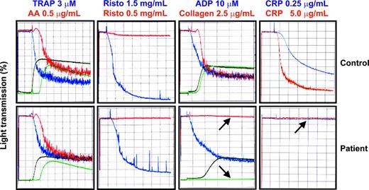 Figure 1. Platelet aggregation and secretion responses. Aggregation studies were performed using a whole-blood lumiionized calcium aggregation system (Chrono-Log). Four hundred microliters of washed platelets in Tyrode-HEPES buffer at 2.5 × 108 platelets/mL were added to siliconized glass cuvettes at 37° C with constant stirring at 1000 rpm. CaCl2 was added to a final concentration of 1 mM, and fibrinogen (Sigma Chemical, St Louis, MO) was added to 300 μg/mL. Platelets from the patient or a healthy control subject were stimulated with thrombin receptor activating peptide (TRAP), arachidonic acid (AA), ristocetin (Risto), ADP, collagen, or CRP. Aggregation was monitored by measuring an increase in light transmission. Secretion is shown in green for arachidonic acid and collagen and in black for TRAP and ADP. Note the specific failure of collagen or the GPVI-specific agonist CRP to induce platelet aggregation or secretion (arrows).