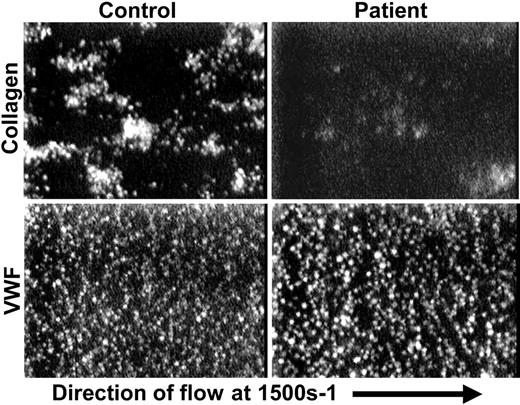 Figure 2. Flow chamber analysis of platelet adhesion and thrombus formation under conditions of arterial shear. Mepacrine-labeled platelets from the patient and a healthy control were placed in parallel-plate flow chambers and perfused at arterial wall shear rates of 1500 s–1 over glass slides coated with VWF or collagen. While patient platelets behave similarly to those from a healthy control when flowed over immobilized VWF (bottom panels), patient platelets adhere to and form thrombi poorly on immobilized collagen (top panels).