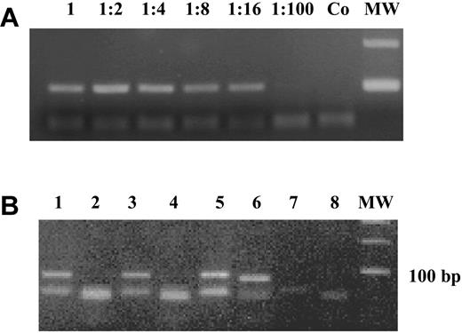 Figure 1. DAP-kinase methylation-specific PCR. (A) A completely methylated sample was diluted 1:2 to 1:100 into an unmethylated DNA and the “methylated” PCR reaction is shown. A distinct band was visible up to a dilution of 1:16 (6.75% positive). Co is the negative control and MW is the 100-bp molecular weight marker. (B) MSP for unmethylated and methylated DAP-kinase for 3 patients (patient a: lanes 1-2; patient b: lanes 3-4; and patient c: lanes 5-6). Adistinct band for the unmethylated reaction is visible at 106 bp for all patients, whereas only the DNAof patient c is methylated (98-bp band). Lanes 7 and 8 are negative controls for unmethylated and methylated DAP-kinase.