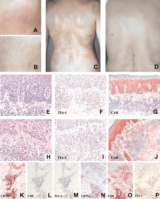 Figure 2. Treatment of patient 2. Patient 2 before (panel A, injected lesion; panel C, noninjected lesions) and after (panel B, injected lesion; panel D, noninjected lesions) TG1042 treatment. Changes in CTCL histology following TG1042 injections (hematoxylin-eosin staining: E, baseline; H, after treatment), TIA-1 (F, baseline; I, after treatment), and CAR (G, baseline; J, after treatment) expression in CTCL. Changes in CD79a, marker for neoplastic B cells (K, baseline; N, after treatment), CD8 (L, baseline; O, after treatment), and TIA-1 (M, baseline; P, after treatment) expression in CBCL. See Table 4. Original magnification, × 40 (E, H); × 20 (F, G, I, J, K-P).