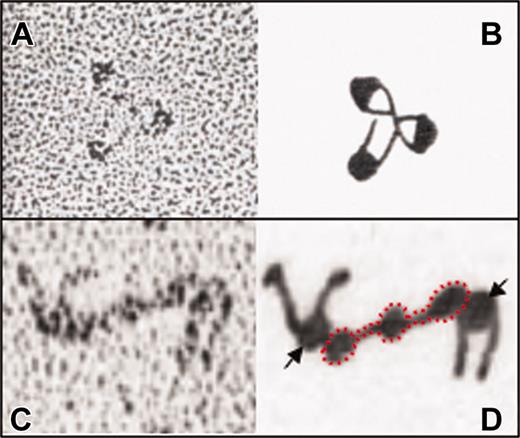 Figure 2. Rotary-stained electron micrographic images of αIIbβ3. The complex is shown in the absence of detergent (A) or bound to fibrinogen (C). Schematic representations of each are shown in panels B and D. Note that the integrin stalks containing the hydrophobic transmembrane domains have a tendency to self-associate, while the head domain (arrows) binds fibrinogen (red outline). Adapted from Carrell et al17 and Weisel et al18 with permission.