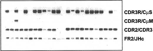 Figure 4. WM B cells express transcripts encoding predominantly the secreted form of clonotypic IgM. Heminested RT-PCR of CD20+CD138+ cells in patient WM1-09 was used to detect membrane-bound and secreted clonotypic μ transcripts. The PCR primer combination is as described in Table 2.