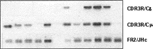 Figure 6. WM B cells coexpress clonotypic IgM and IgD transcripts. Representative analysis of clonal isotypes in multiple individual cells from the same patient is shown. cDNA from individual CD20+ cells of patient WM1-09 was split into separate aliquots, and heminested PCR was run in parallel experiments using the combination of primer sets described in Table 2. Percentages of cells expressing single or double clonal isotypes of each patient were calculated and summarized in Table 4.