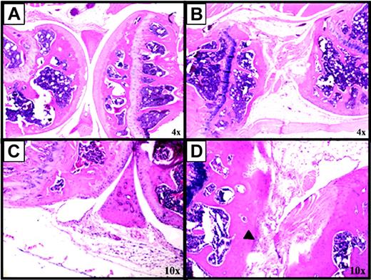 Figure 2. Blood-induced synovitis as a murine model of human HS. Factor VIII-deficient mice were subjected to a controlled blunt trauma to the right knee joint to induce 2 (days 0 and 7) or 3 (days 0, 7, and 14) episodes of hemarthrosis one week apart. Sham injury was performed on the left knee at each time point. (A) Normal appearance of a right knee joint from a mouse killed on day 0, not having had hemarthosis. (B) Abnormal appearance of a right knee joint from a mouse killed on day 14 following 2 episodes of hemarthrosis. (C) Normal appearance of the left knee of a mouse killed on day 14 after sham injury. (D) A mouse killed on day 21 after 3 episodes of hemarthrosis. Hematoxylin and eosin-stained sections of murine knee joints. More than 20 mice have been evaluated in 4 different experiments with similar results. Images were acquired using a CK2 microscope (Olympus, Melville, NY), objective lenses 4×, 0.10 (A-B) or 10×, 0.25 (C-D), and a DP12 microscope digital camera system with DP-Soft acquisition software (Olympus).