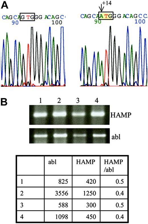 Figure 1. DNA and RNA analysis. (A) DNA sequencing of the HAMP gene led to identification of a new mutation at position +14 from the Cap site of the mRNA. Left side: wild-type nucleotide G at position +14; right side: mutated nucleotide A. (B) RNA was extracted from a biopsy obtained from the proband's liver and analyzed by RT-PCR for the presence of HAMP cDNA. The ethidium bromide stained agarose gel shows similar expression of the patient's HAMP cDNA (lane 4) compared with cDNA obtained from normal (lanes 1-2) and cirrhotic livers (lane 3). RT-PCR for abl was performed in parallel to ensure that equal quantities of cDNA were used for each PCR. Real-time PCR was performed for a more accurate determination of HAMP cDNA levels. The table shows only minor variations of the HAMP/abl ratios between the different samples (1-2, normal liver; 3, cirrhotic liver; 4, proband's liver).