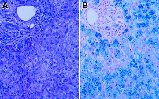 Figure 1. Liver biopsy. Hematoxylin and eosin (A) and Prussian blue iron (B) stains of the patient's liver biopsy specimen at the time of diagnosis, demonstrating heavy (4+) hepatocellular iron deposition. Slides were viewed with a Nikon Eclipse E600 microscope equipped with a 40×/0.75 objective lens (Nikon, Melville, NY). An RT Slider SPOT 2.3.1. camera and SPOT advanced software (v.3.5.9; Diagnostic Instruments, Sterling Heights, MI) were used to capture images.