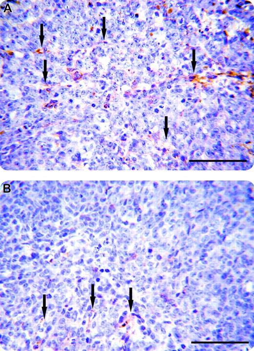 Figure 4. Visualization of vessels in human colon carcinoma. Immunochemistry sections. The tumor sections were incubated with monoclonal CD31 antibody (PECAM) using the immunoperoxidase technique. The vessel walls (arrows) stained golden-brown. (A) Human colon carcinoma treated with murine IgG. (B) Human colon carcinoma treated with mAb C11C1. There were fewer vessels apparent in the C11C1-treated group. Bars represent 100 μm.