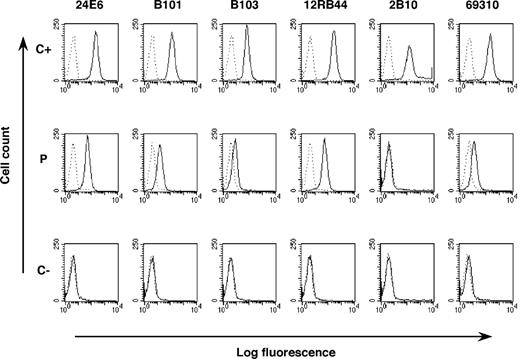 Figure 2. IL-12Rβ1 chain detected at the cell surface by FACS analysis. PHA-T-cell blasts from a positive control (C+), the patient (P), and a negative control (C-) were stained with various purified mouse monoclonal antibodies (24E6, B101, B103, 12RB44), rat mAb (2B10), or matched isotype control, followed by biotinylated matched Ab and phycoerythrin-conjugated streptavidin. IL-12Rβ1 clone 69310, directly conjugated to R-PE, was compared with a matched conjugated isotype control. Specific signals are represented as plain lines; matched isotype controls are represented as dotted lines.