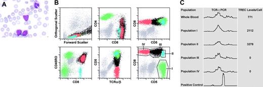 Figure 1. Blood findings: morphologic, flow cytometric, and molecular studies. (A) The morphologic appearance of the “atypical” lymphoid cells is shown in the peripheral blood of the patient (magnification × 1000). (B) Six representative dot plots from the flow cytometric studies are shown. The population in green (population I) represents CD4+ T lymphocytes. The 3 subpopulations of CD8+ T lymphocytes (populations II, III, and IV) are represented in blue, black, and red, respectively. The regions drawn around populations in the sixth dot plot approximate the electronic gates used for flow-sorting the corresponding subsets. (C) Shown are the results from the TCR-γ PCR reactions performed on genomic DNA extracted from either bulk blood leukocytes or sorted populations of T cells (as indicated). The bottom row indicates a positive control PCR reaction (monoclonal TCR). TREC levels (per cell) from the corresponding populations are also indicated in the same panel to the right of each tracing.