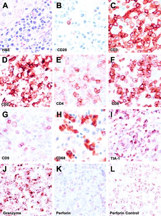 Figure 2. Liver biopsy. (A) The H&E-stained liver section is shown. (B-K) These panels represent immunohistochemical staining for CD20, CD3, CD2, CD4, CD8, CD5, CD68, TIA-1, granzyme B, and perforin. (L) Positive perforin staining is shown on a control section (spleen). All images are at × 500 magnification. The infiltrate is composed predominantly of CD8+ T cells with lack of perforin expression (FHL) and lack of CD5 expression, similar to flow cytometric findings.