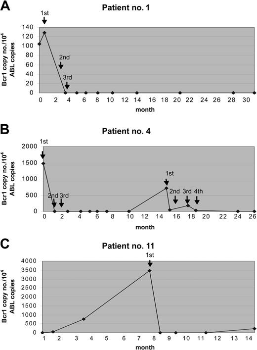 Figure 2. Results of Rt-Q-PCR studies from 3 patients during the therapy with GO. The fusion gene copy number was normalized to the control gene ABL, and the results were expressed in PML/RARα copy numbers per 104 copies of ABL. The arrows indicate the time of GO administrations. (A) Patient no. 1 received 3 doses and remained in sustained MR for 31 months. (B) Patient no. 4 experienced a relapse and was treated again with GO; this patient obtained a second MR after 4 additional GO doses. (C) Patient no. 11 achieved MR after the first GO dose and received no further therapy owing to grade 3 hepatic toxicity.
