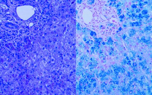 Liver biopsy. See the complete figure in the article beginning on page 2176.