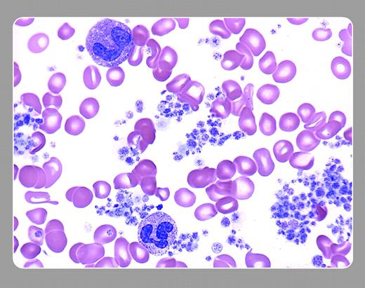 Peter Maslak, Memorial Sloan-Kettering Cancer Center