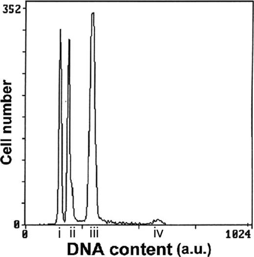 Figure 2. Representative histogram of ALL case number 19 with both hypodiploid with 30 to 39 chromosomes and near-triploid clones. G1 peak of the hypodiploid clone (i); G1 peak of the diploid clone (ii); G1 peak of the near-triploid clone (iii); G2 peak of the near-triploid clone (iv); a.u. indicates arbitrary unit.
