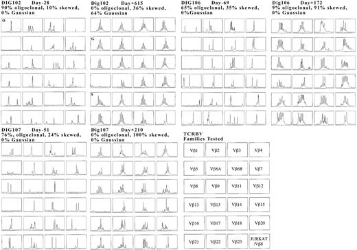 Figure 3. Immunoscope evaluation. Evaluation of DIG102, DIG106, and DIG107 before and after thymus transplantation. The RT-PCR was done on CD4 RNA for the posttransplantation panels of DIG106 and DIG107; it was done on PBMC RNA for the other panels. The final panel includes the identification of the TCRBV families. Examples of oligoclonal (O), polyclonal skewed (S), and polyclonal Gaussian-like (G) panels are indicated in the DIG102 profiles. The pretransplantation profiles have been reported17 and are reprinted with permission from the American Academy of Allergy, Asthma, and Immunology. Copyright 2004.