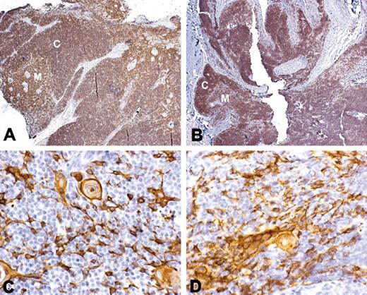 Figure 4. Thymus histology following transplantation. (A,C) Normal thymus; (B,D) biopsy from DIG107 conducted at 3 months after thymus transplantation. Panels A and B show staining with CD3 antibody (original magnification ×10). Panels C and D show staining with cytokeratin. Positive reaction with antibody is indicated by the brown color. Both cortex (C) and medulla (M) containing light lacy cytokeratin-positive epithelial cells and Hassall bodies are evident in the transplant biopsy from this patient.