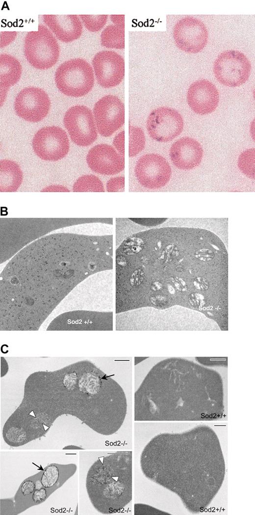 Figure 1. Iron deposition and morphology on EM of SOD2-deficient red cells. (A) Modified Perl stain of peripheral blood from recipients of Sod2+/+ or Sod2–/– fetal liver transplants (as a source of hematopoietic stem cells) demonstrating excess iron on SOD2-deficient cells. (B) Electron micrographs of Sod2+/+ and Sod2–/– reticulocytes reveal an increased number of mitochondria with prominent intramitochondrial membranes in SOD2-deficient cells. No obvious foci of iron deposition (electrondense material) were seen within SOD2-deficient cells with standard EM processing. (C) Electron micrographs of reticulocytes prestained with potassium ferricyanide prior to processing. Small arrows show diffuse electron-dense deposits in matrix of mitochondria, and large arrows show strong electron-dense deposits in the outer mitochondrial membrane of Sod2–/– cells. Bar length is 500 nm.