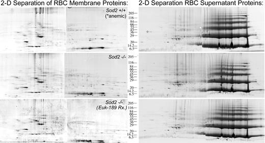 Figure 7. Representative 2-D gel analysis of membrane and soluble protein preparations from Sod2+/+, Sod2–/–, and Euk-189–treated Sod2–/– red cells. Membrane (200 μg) or soluble red cell protein (400 μg) was separated by 2-D gel electrophoresis. Sod2+/+ red cell samples were obtained from serially phlebotomized animals (in order to induce reticulocytosis similar to that seen in Sod2–/– samples). Each sample was prepared from pooled red cells obtained from 5 donor animals.