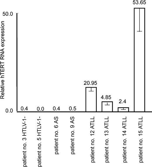 Figure 5. Up-regulation of the hTERT expression in in vivo ATLL patient samples. Real-time PCR measure of hTERT mRNA expression in 2 donors negative for HTLV-I, 2 asymptomatic carriers (AS), and 4 ATLL patients was performed as described in “Materials and methods.” The expression level in nonactivated cultured PBMCs (shown in Figure 1A) was defined as 1.0. Experimental variations are indicated by error bars.