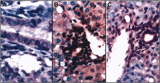 Figure 3. In situ hybridization shows that cells within the vessel walls and biliary ducts are of human origin. Combined in situ hybridization and immunohistochemistry were performed on liver sections from sheep that underwent transplantation using a probe specific for the human Alu sequence and an antibody specific for human CD45. (A) Control (no transplantation) sheep. (B-C) Two different sections show numerous cell nuclei within the vessel walls and biliary ducts stained dark brown, demonstrating that they are of human origin. None of these cells exhibit red staining for CD45.