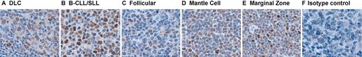 Figure 4. Expression of BLyS in NHL tumors. Immunohistochemical analysis of BLyS expression in (A) DLC, (B) B-CLL/SLL, (C) follicular, (D) mantle cell, and (E) marginal zone NHL specimens (n = 5 for each histologic subtype) was performed with the anti-BLyS mAb from Chemicon as described in “Patients, materials, and methods.” An isotype control was done for each specimen and a representative example is shown in panel F. Original magnification × 400.