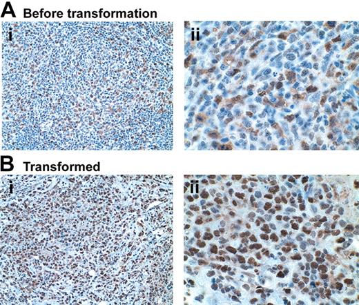 Figure 5. Increased BLyS expression with transformation from follicular to large cell NHL. Immunohistochemical analysis of BLyS expression in biopsy specimens from a patient with follicular lymphoma before (Ai, original magnification × 200; Aii, original magnification × 600) and after (Bi, original magnification × 200; Bii, original magnification × 600) transformation from follicular to large B-cell lymphoma.