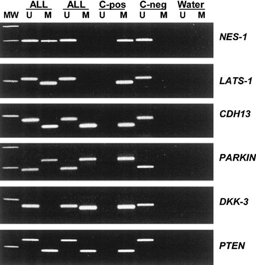 Figure 1. Aberrant promoter methylation of different genes in acute lymphoblastic leukemia. MW indicates molecular weight marker; ALL, acute lymphoblastic leukemia samples; C-pos, human male genomic DNA universally methylated for all genes (used as a positive control for methylated alleles); C-neg, healthy individual; water, blank control without DNA added; U, unmethylated alleles; and M, methylated alleles.