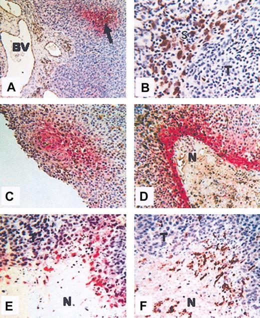 Figure 1. Colocalization of hypoxia and macrophages. Colocalization in human squamous carcinoma of the uterine cervix (A-D) and human PC3 (prostate carcinoma) xenografted tumors grown in nude mice (E-F). (A) Hypoxic areas (arrow), visualized by immunolabeling of the reductively activated hypoxic-specific marker pimonidazole (red), are observed at a distance from the disorganized blood vessels (BV). (B) In some areas of these tumors, CD68+ TAMs (brown) accumulate in stromal (S) rather than tumor (T) areas. (C-D) Colocalization of TAMS (brown) and hypoxia (red) showing TAM accumulation in avascular, perinecrotic, necrotic (N), and hypoxia areas. (E-F) Serial sections showing F4/80-positive (brown; panel F) TAMs in hypoxic, perinecrotic areas (red; panel E) of PC3 tumors. N indicates necrosis; and T, tumor. The microscope used was a Leitz Orthoplan. Magnification of panel A, Ă— 100; panel B, Ă— 400; panel C, Ă— 160; panel D, Ă— 160; panel E, Ă— 160; panel F, Ă— 160 (panels D-F, cropped images). Slight adjustments were made in brightness and contrast on each whole image. The temperature was room temperature. The imaging medium was DPX. Chromogens used were DAB (brown) 3,3-diaminobenzene and vector red (red) (Vector Laboratories, Burlingame, CA). The camera was a Fuji HC 3002 digital camera. Image processing was performed by Photograb 3002 (Windows platform).