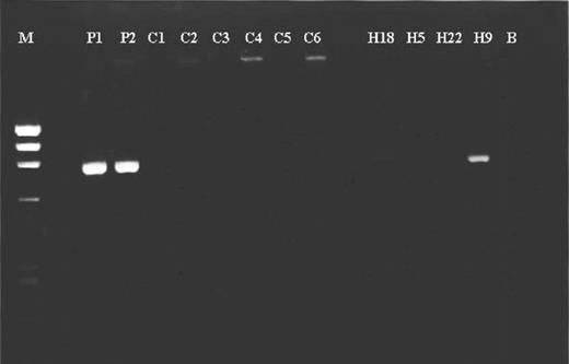 Figure 1. Amplification of 836-bp fragment across the deletion. P1 and P2 are genomic DNA from the 2 patients, C1-C6 are control DNAs, H18 and H9 are haploid hybrids containing the deletion, H5 and H22 are the hybrids containing the undeleted allele, M is a PhiX174/HaeIII size marker, and B is the negative control.