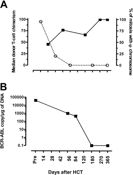 Figure 6. CML patient with complete cytogenetic remission before achieving full donor T-cell chimerism. (A) Evolution of T-cell chimerism (black squares, solid line) and percentages of mitoses with Philadelphia chromosome determined by conventional cytogenetics (open circle, broken line). (B) Achievement of molecular remission.