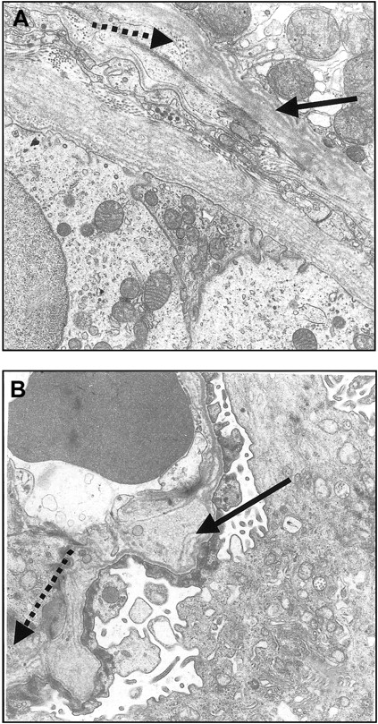 Figure 3. Electron micrographs of kidney biopsy specimens showing glomerular and tubular basement membrane of Pt1. (A) Thickening and splitting of the tubular basement membrane (arrow) and granular inclusion of electron-dense particles (dotted arrow). Magnification × 17 000. (B) Focal thickening and irregularity of the glomerular basement membrane with splitting of the lamina densa (arrow) and inclusion of electron-dense particles (dotted arrow). Magnification × 17 000.