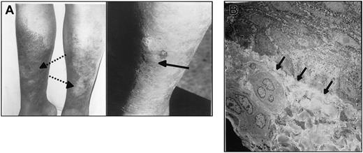 Figure 4. Pretibial epidermolysis bullosa in Pt2. (A) Photograph showing bullous skin lesion (arrow) with adjacent atrophy and scarring (dotted arrows). (B) Slitlike separation of epidermis from dermis (arrows). Magnification × 20 000.