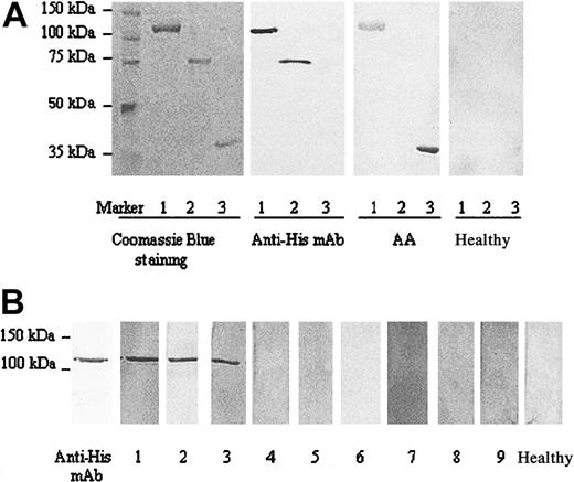 Figure 1. Specific antibody to recombinant DRS-1 in the serum of an AA patient. (A) Purified His-tag DRS-1, His-tag, and native DRS-1 were loaded in lanes 1, 2, and 3, respectively. Proteins were visualized using Coomassie blue staining. Blotted membranes were incubated with anti-His mAb, serum of a PNH+ AA patient, and serum of a healthy individual for detection of DRS-1 Abs. (B) An equal amount of purified His-tag DRS-1 protein was used to detect antibodies specific to DRS-1 in sera from 3 PNH+ AA patients (lanes 1-3), 3 PNH– AA patients (lanes 4-6), 3 PNH– MDS patients (lanes 7-9), and a healthy individual (Healthy).