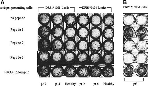 Figure 6. Frequency of T-cell precursors specific to the DRS-1 epitope. (A) PBMCs of a DRS-1 Ab+ patient (pt 2), a DRS-1 Ab– patient (patient 4; pt 4), and a healthy individual were subjected to ELISPOT assay using different combinations of APCs and DRS-1–derived peptides. (B) Another DRS-1 Ab+ patient (pt 3) was subjected to ELISPOT assay. The figure shows results of duplicate culture.